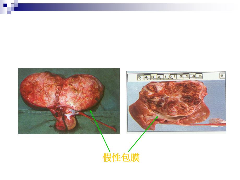 泌尿系肿瘤病人的护理._第3页