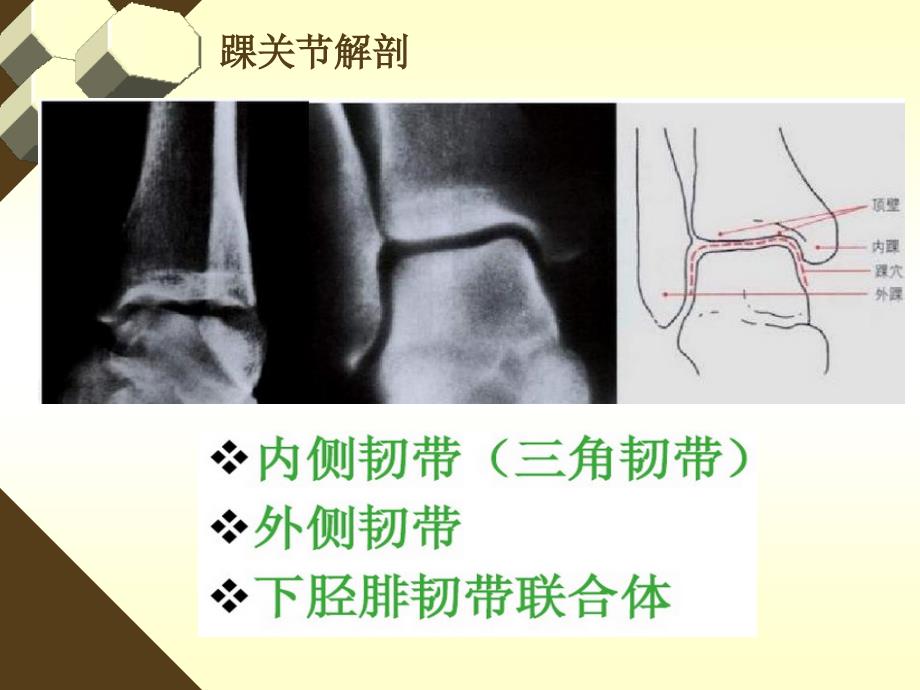 踝关节LH骨折分型_第4页