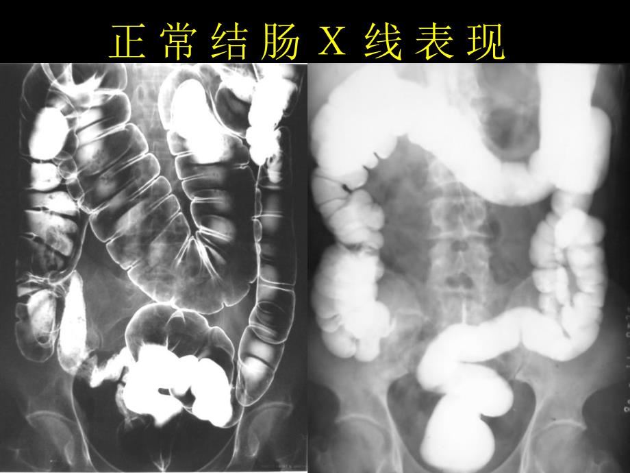 结直肠肿瘤影像诊断、下咽部及十二指肠肿瘤影像诊断_第2页