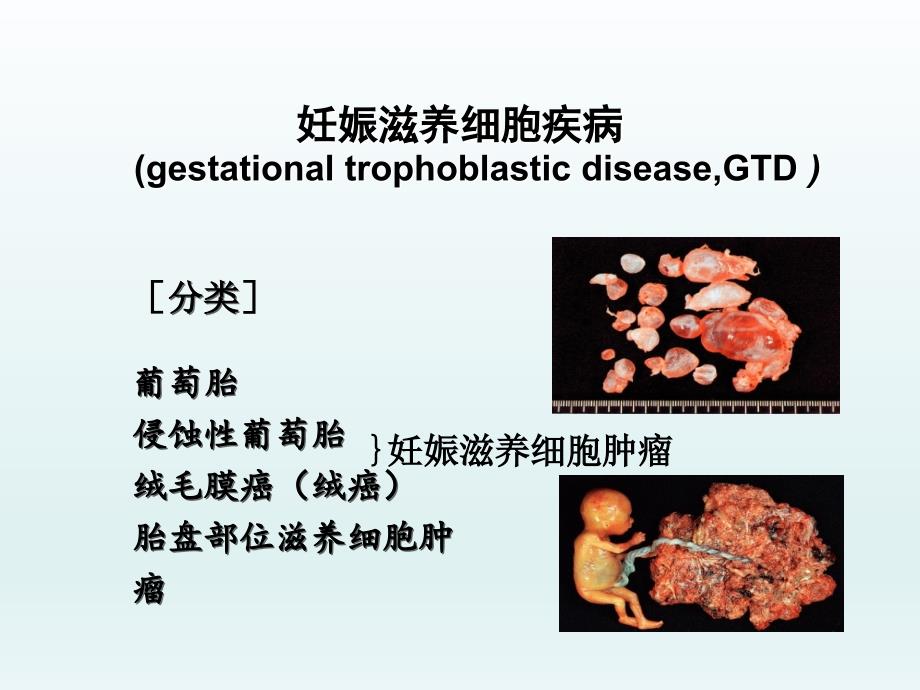 妇产科学-妊娠滋养细胞疾病_第3页