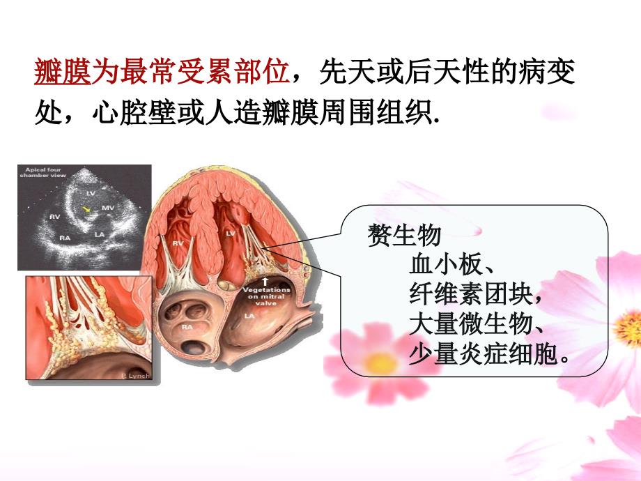 感染性心内膜炎护理查房ppppt课件_第3页