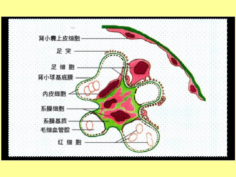 病理学肾小球肾炎与肾盂肾炎_第5页