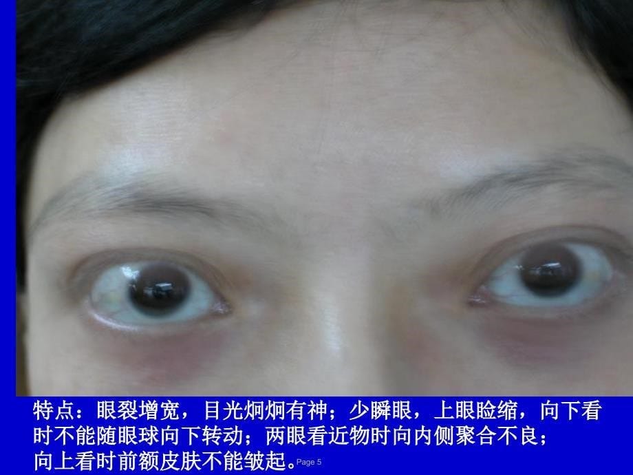 甲状腺疾病课件岑溪妇幼保健院莫峰光_第5页