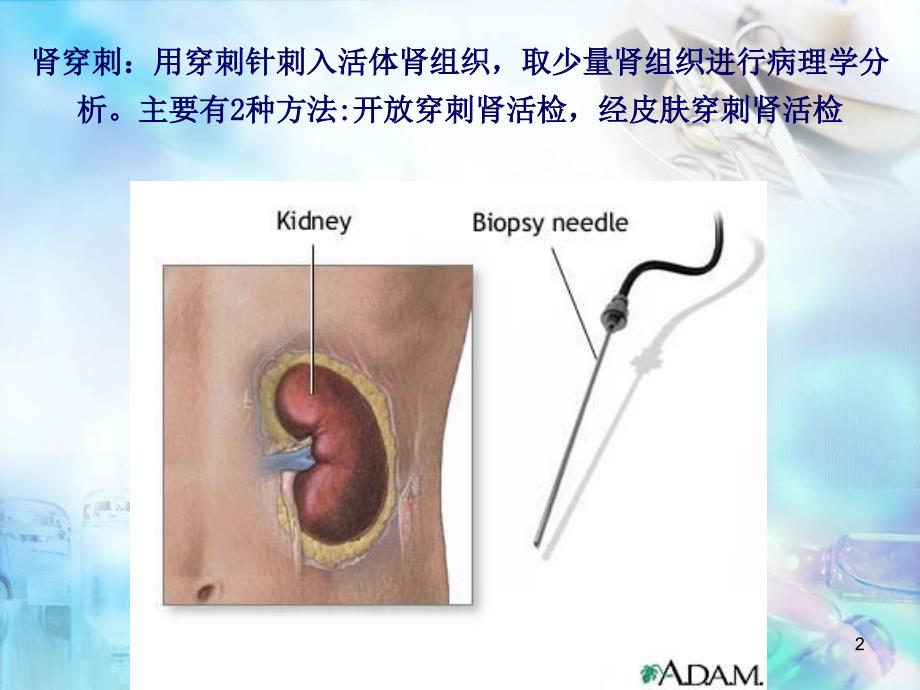 （优质课件）肾穿刺活检最新版_第2页