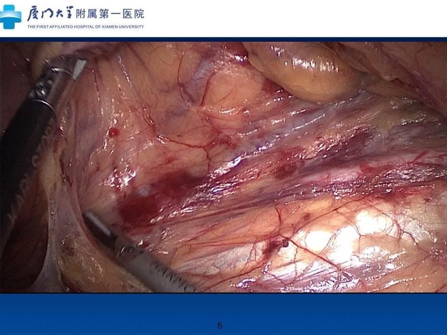 左半结肠的微创解剖及临床意义_第5页