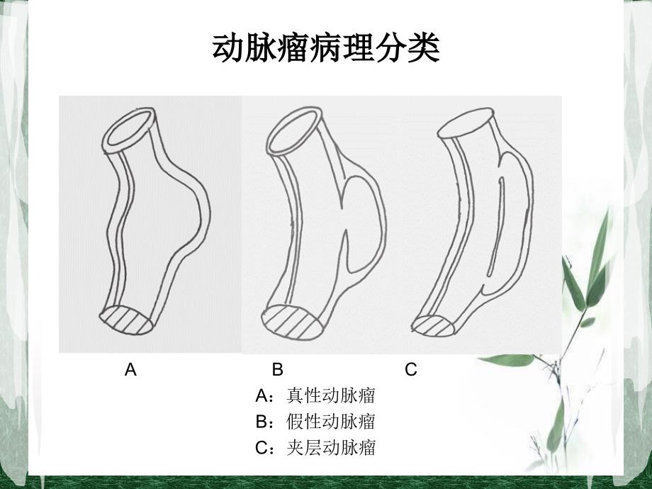 假性动脉瘤的治疗与护理最终版_第4页