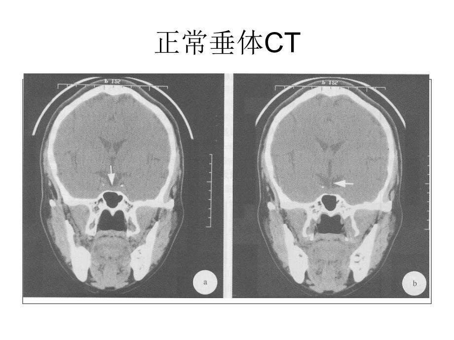 垂体影像学课件_第1页