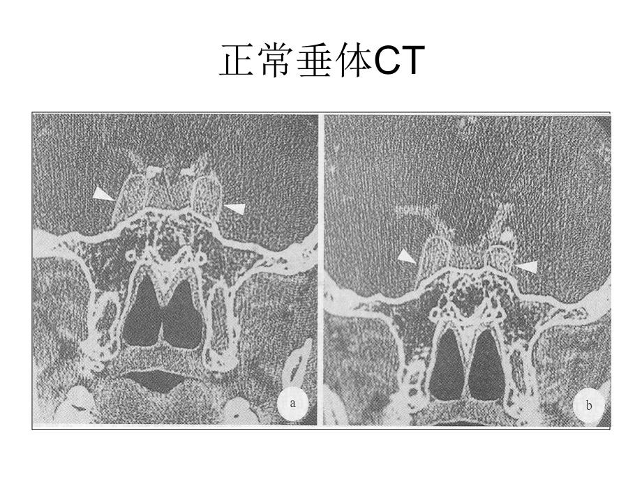 垂体影像学课件_第2页