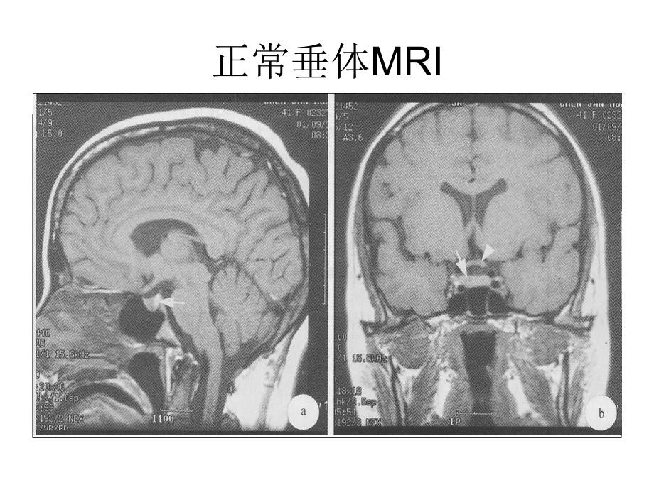 垂体影像学课件_第3页