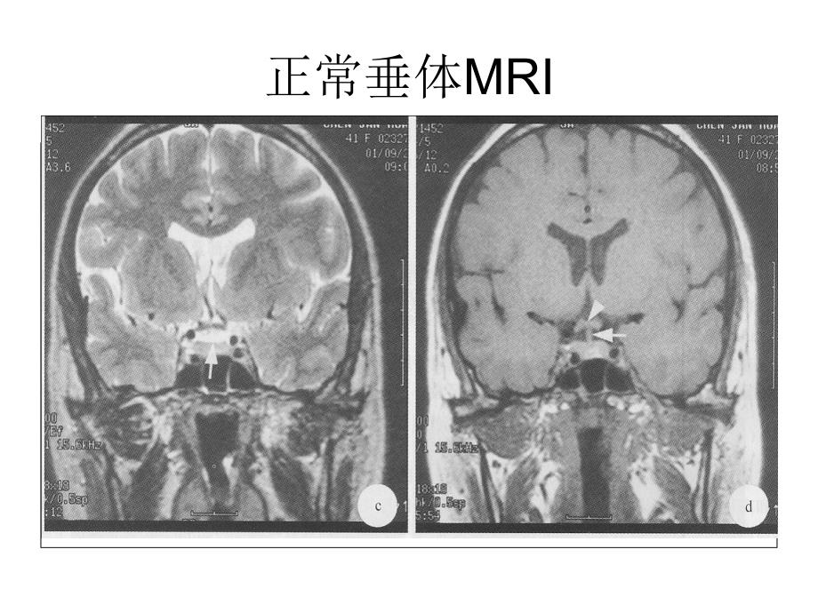 垂体影像学课件_第4页