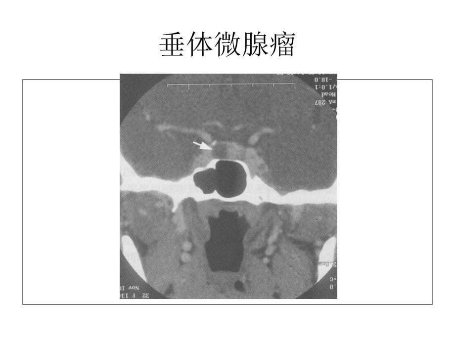 垂体影像学课件_第5页