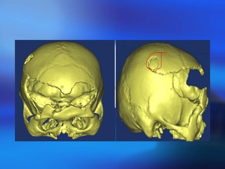 脑外科科技进步数字化颅骨修补技术_第5页