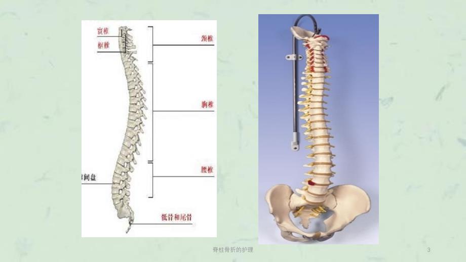 脊柱骨折的护理课件_第3页