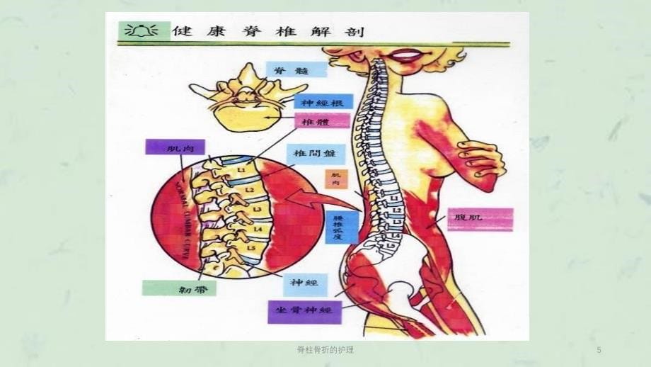 脊柱骨折的护理课件_第5页