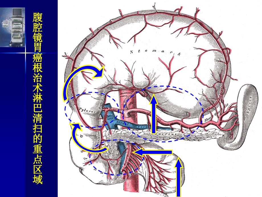 腹腔镜下远端胃癌根治术ppt课件_第4页