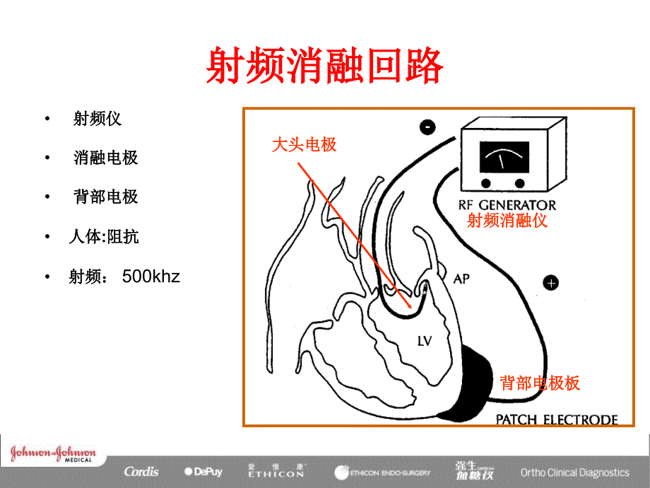 射频消融原理_第3页