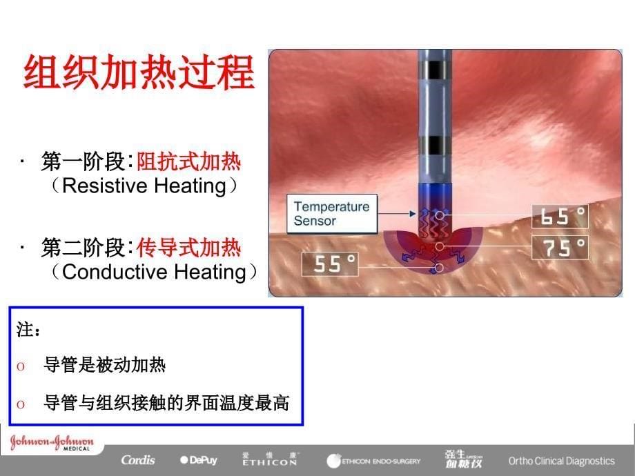 射频消融原理_第5页