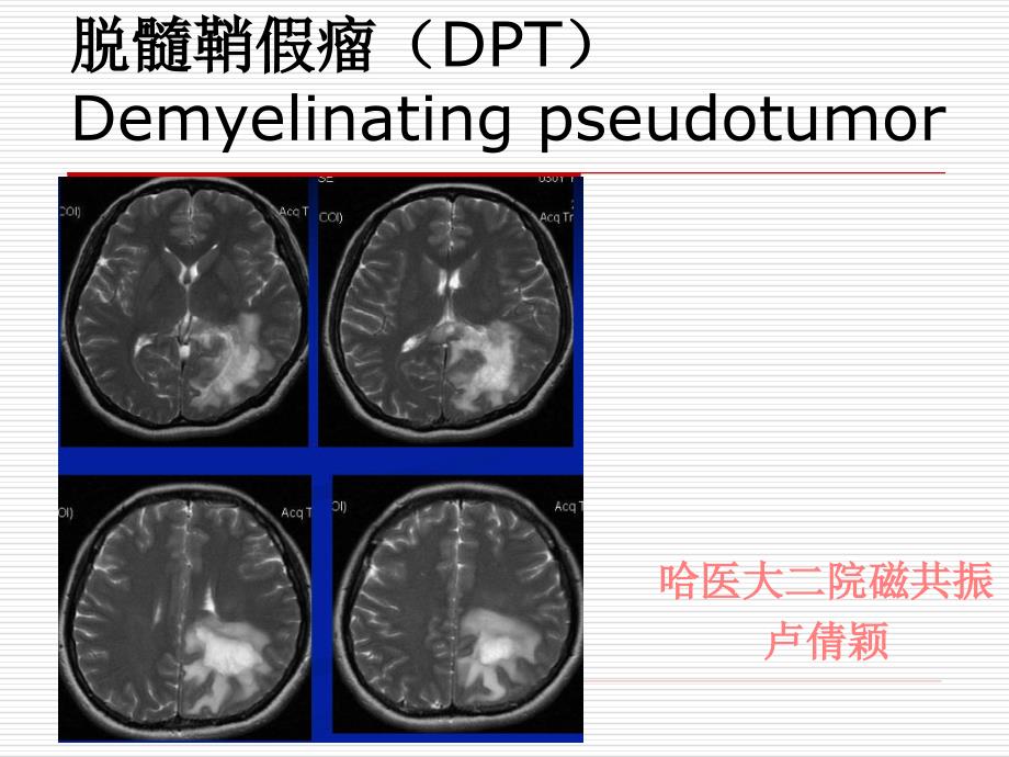 脱髓鞘假瘤mri诊断ppt课件_第1页