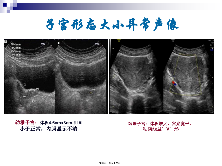 2022医学课件妇科超声常规检查风险评估-(NXPowerLite)_第5页