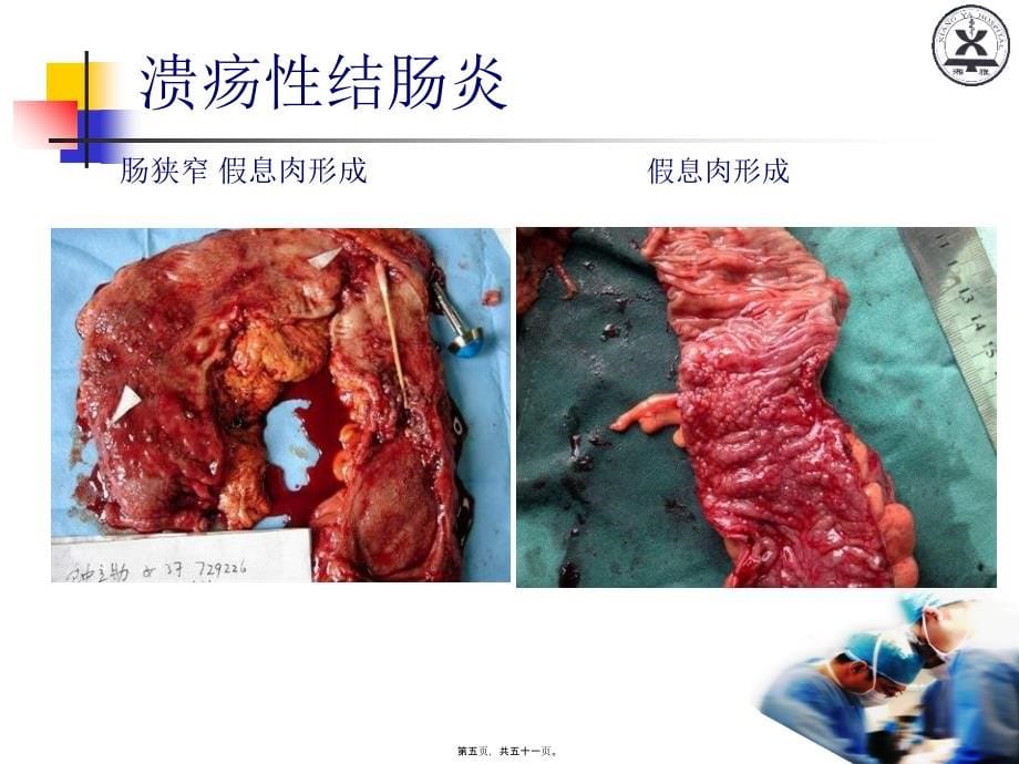 2022医学课件大肠癌晏教授讲义_第5页