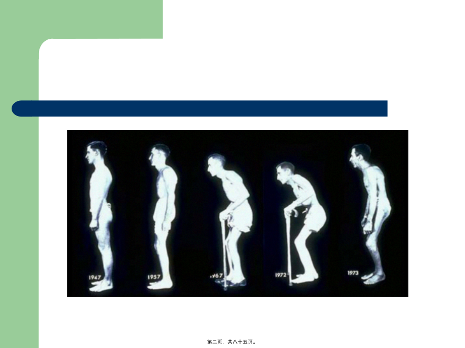 2022医学课件僵直性脊椎炎的中西医观点_第2页