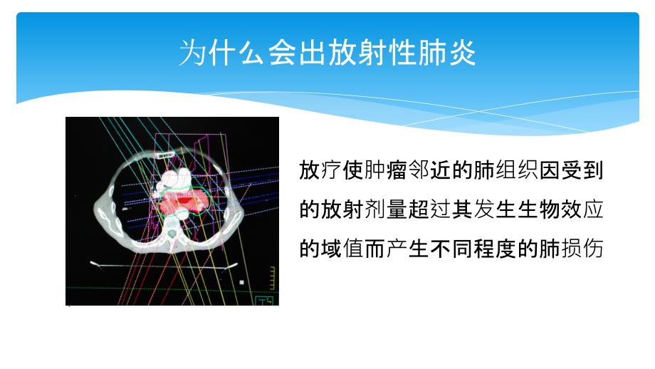 放射性肺炎相关知识_第4页