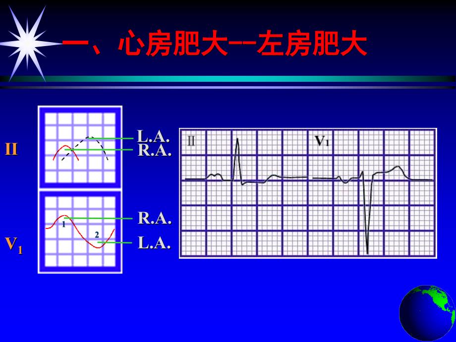 心房、心室肥大_第4页