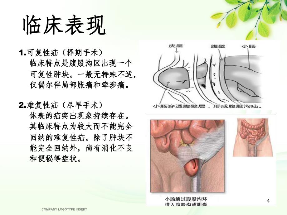 腹股沟斜疝健康宣教PPT精品文档_第4页