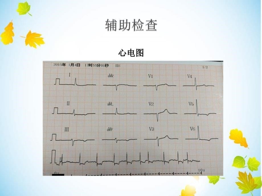 快慢综合征护理查房_第5页