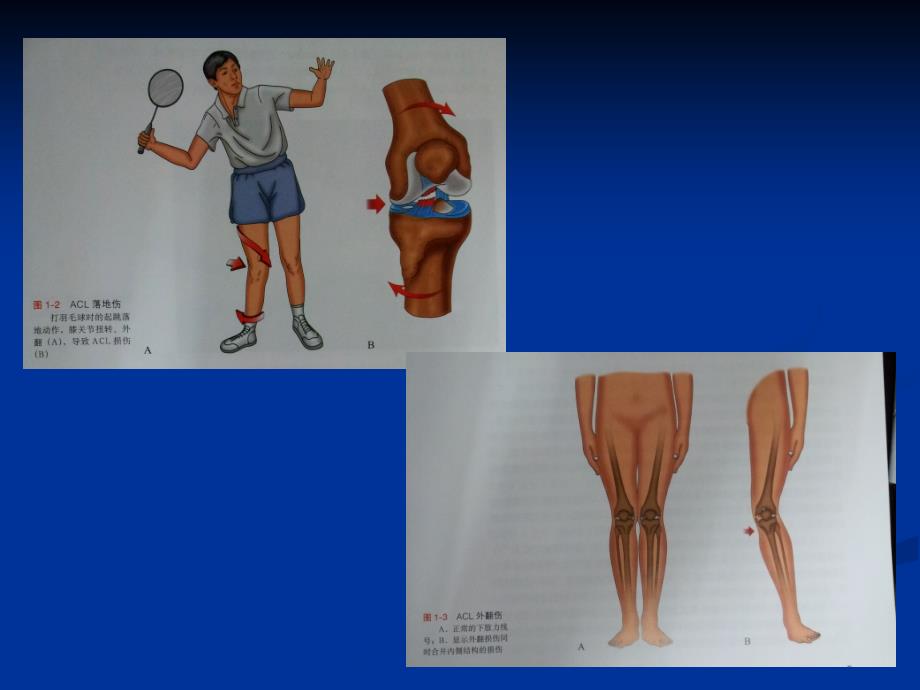 前交叉韧带损伤诊疗常规_第3页