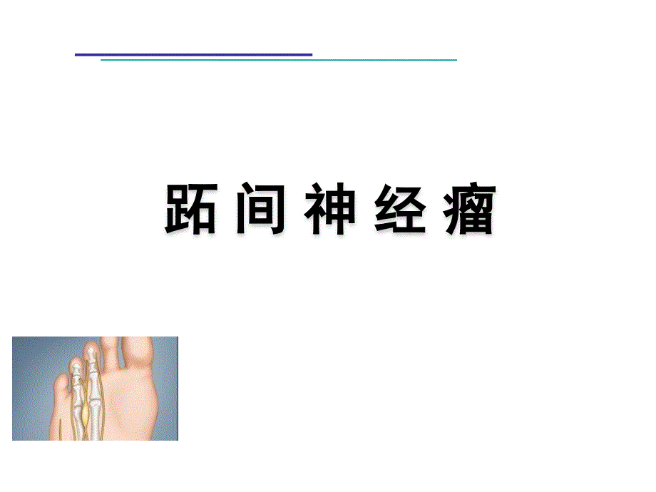 跖间神经瘤课件_第1页