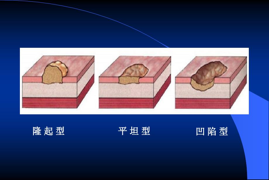 《消化系统肿瘤》PPT课件.ppt_第3页