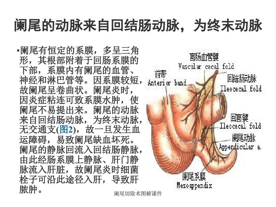 阑尾切除术图解课件_第5页