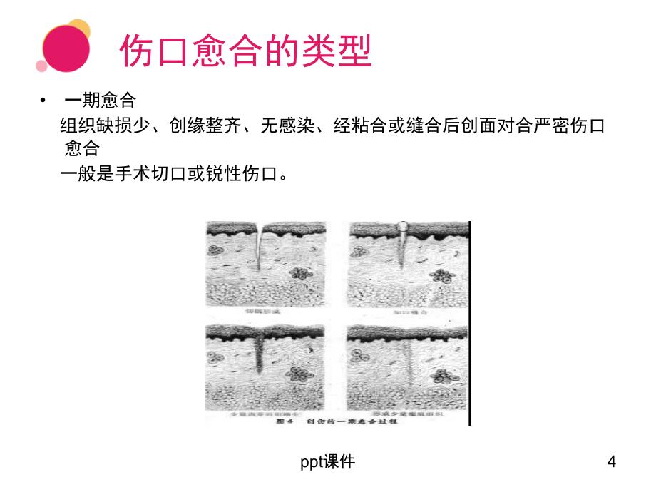 伤口清创的方式和注意事项--课件_第4页