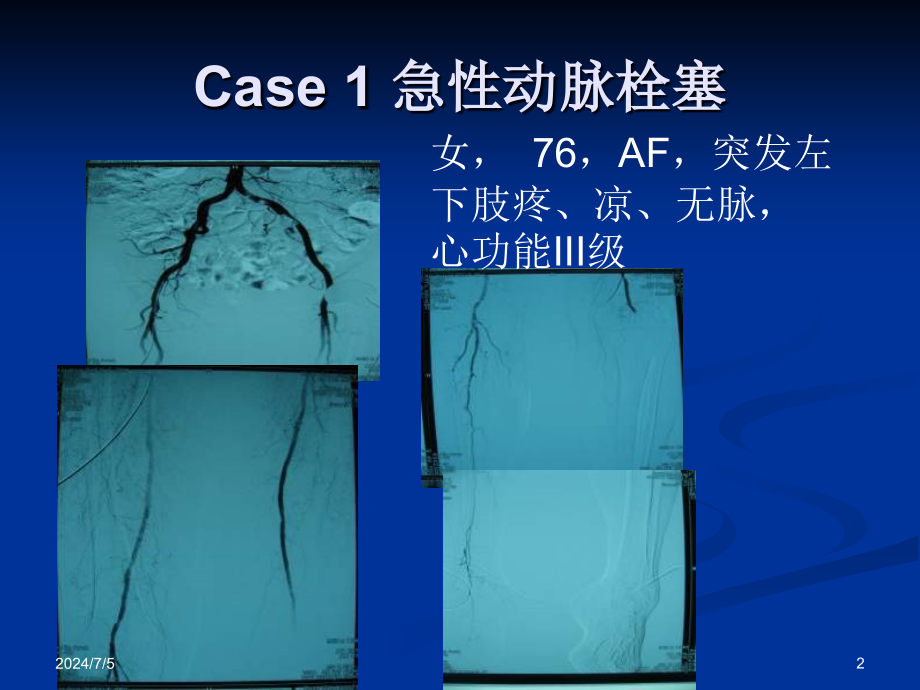 导管接触溶栓在下肢缺血中的应用_第2页