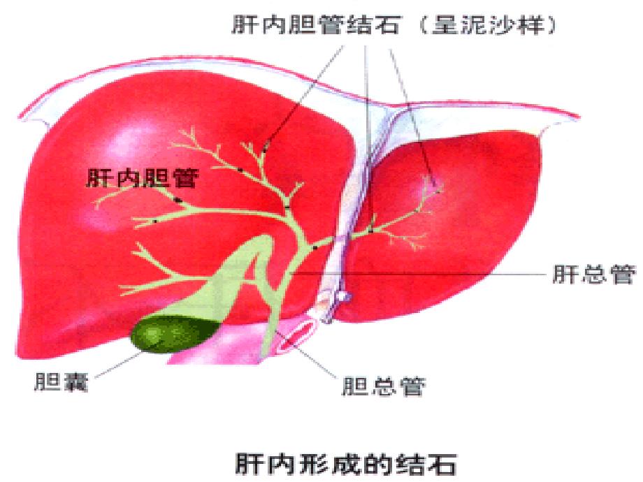 肝内外胆管结石病人的护理毛阿丽.ppt_第4页