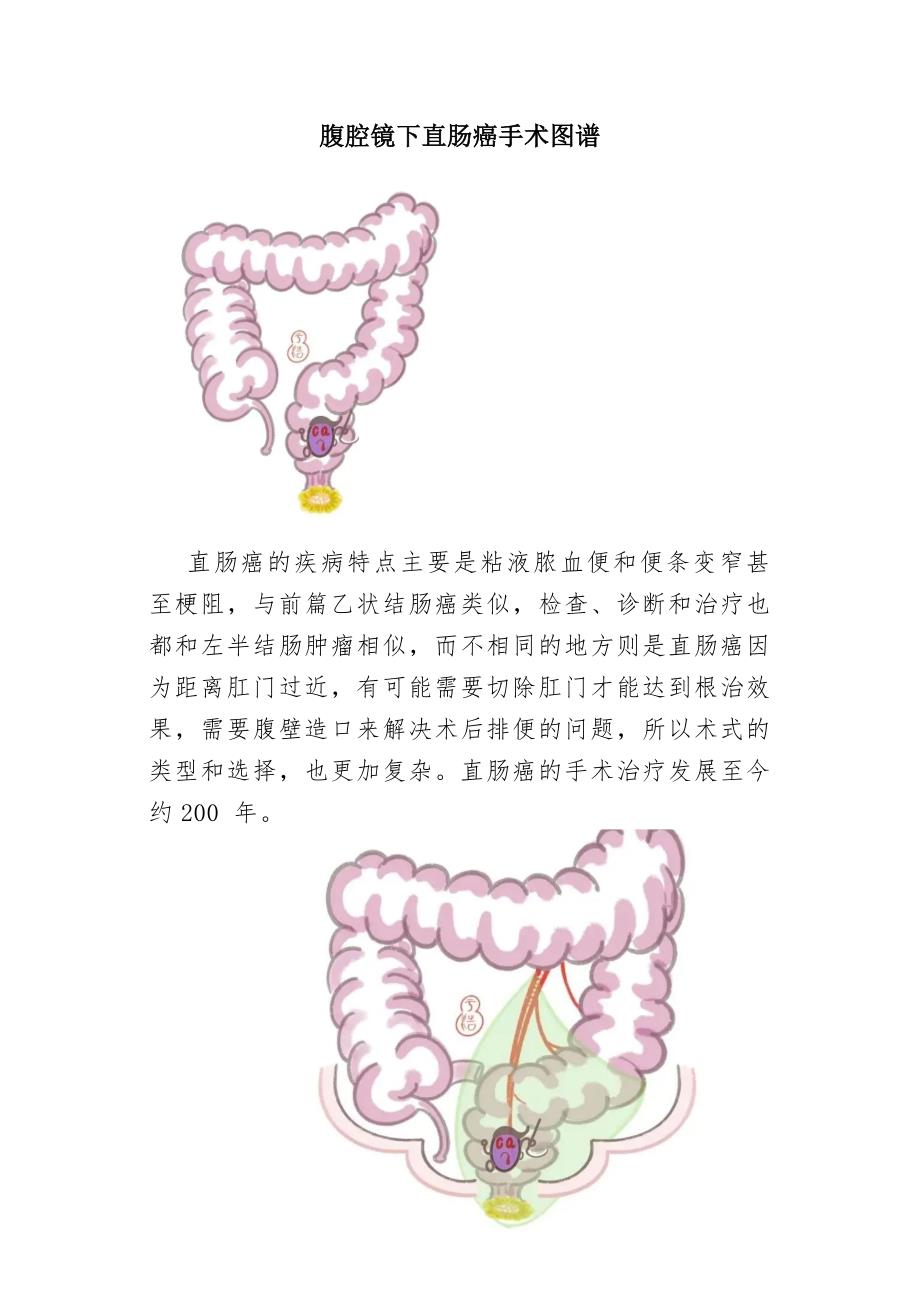 腹腔镜下直肠癌手术图谱_第1页
