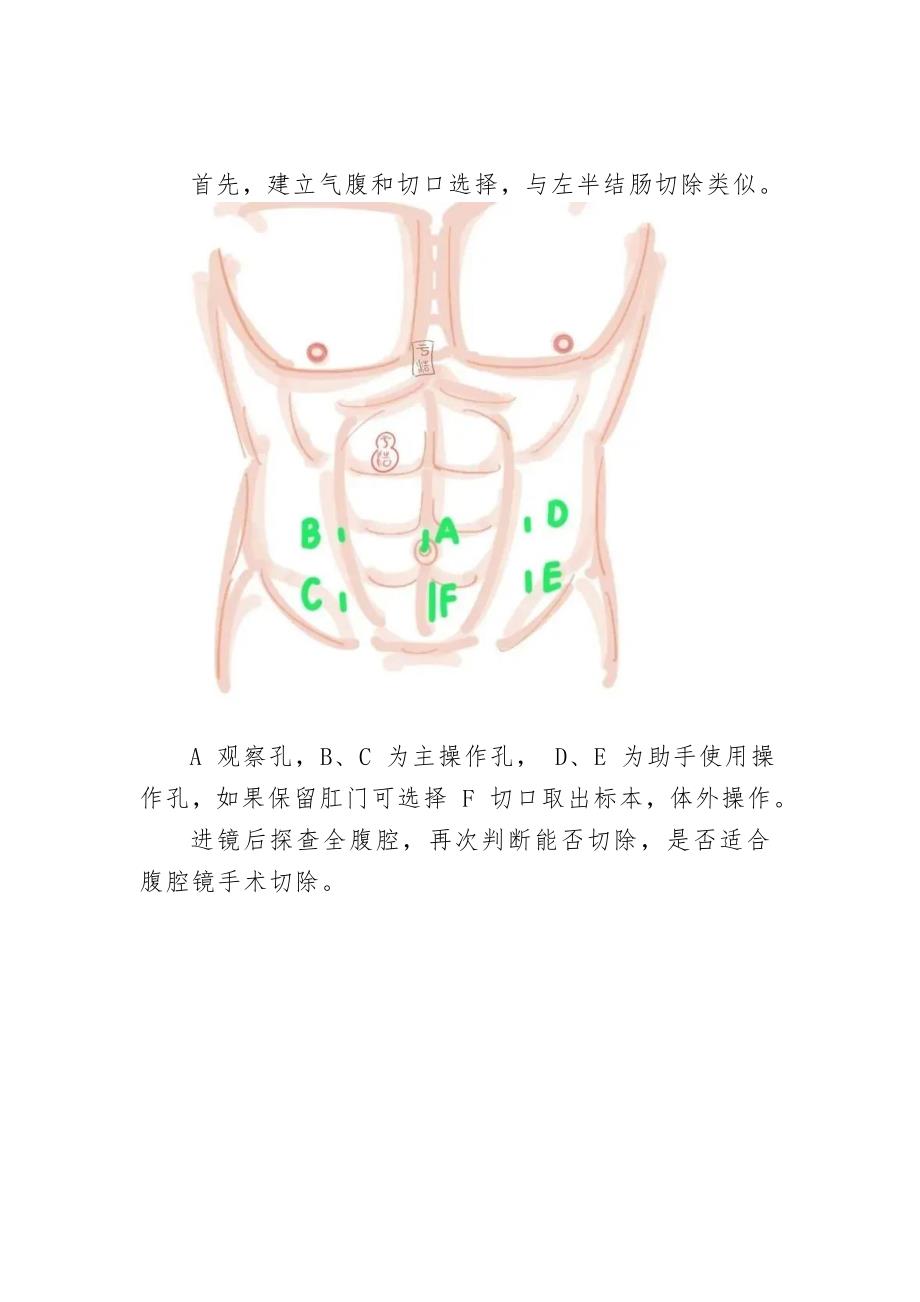腹腔镜下直肠癌手术图谱_第4页