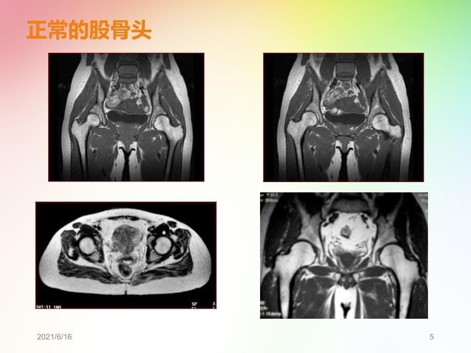 关于股骨头坏死MRI影像表现的学习心得_第5页