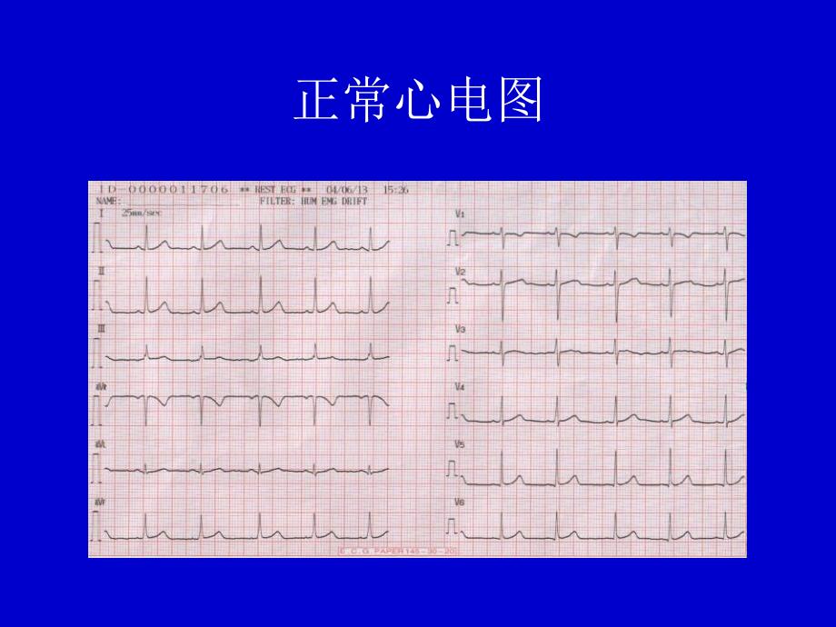 心律失常心电图表现_第2页