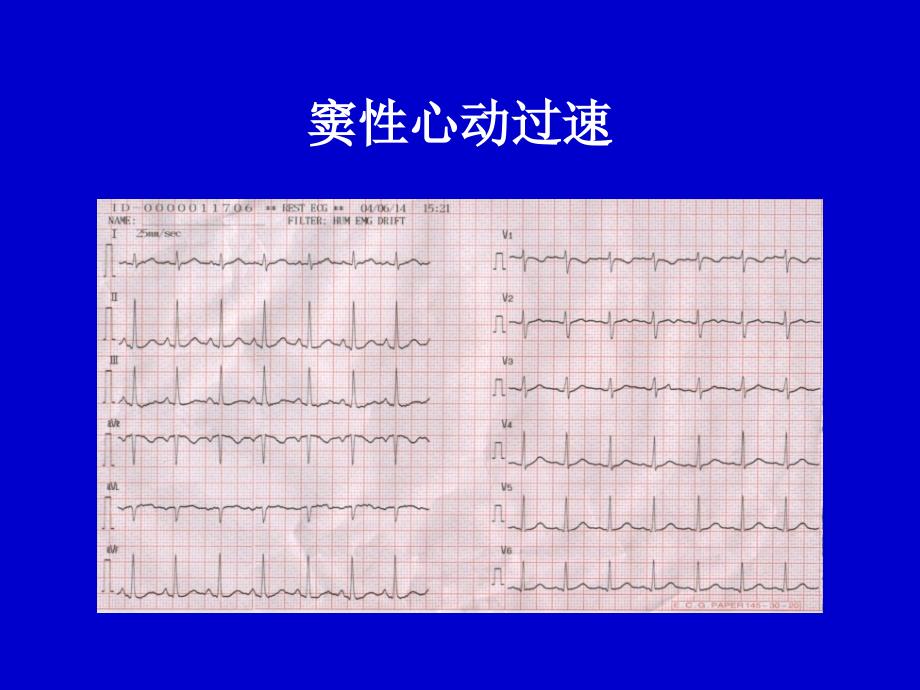 心律失常心电图表现_第4页