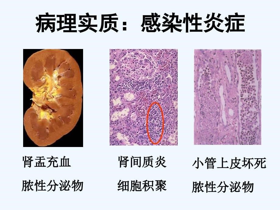 急性肾盂肾炎[可修改版]课件_第5页