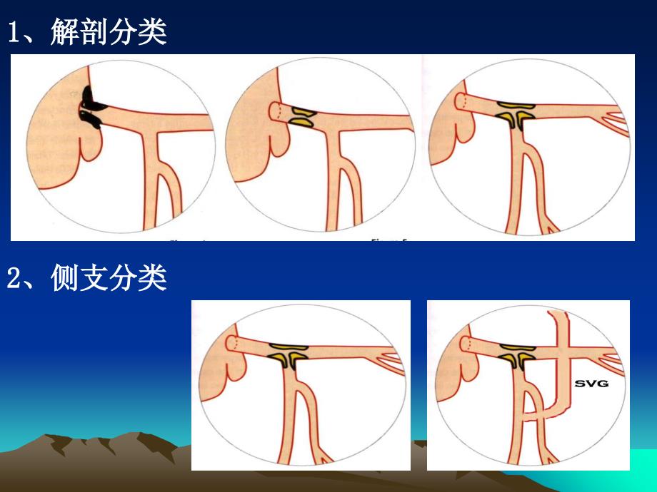 左主干病变的介入治疗策略_第4页