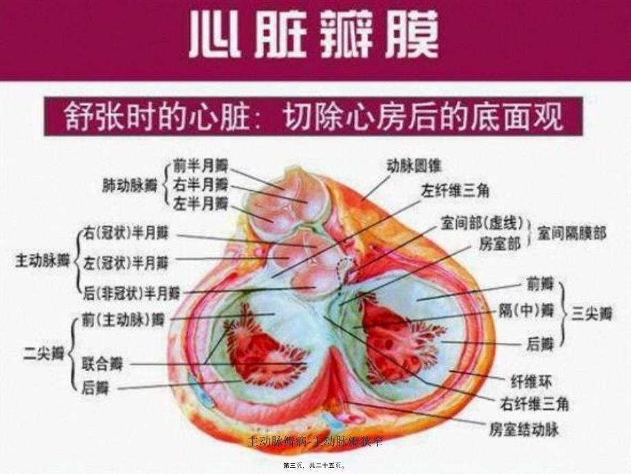 主动脉瓣病主动脉瓣狭窄课件_第3页