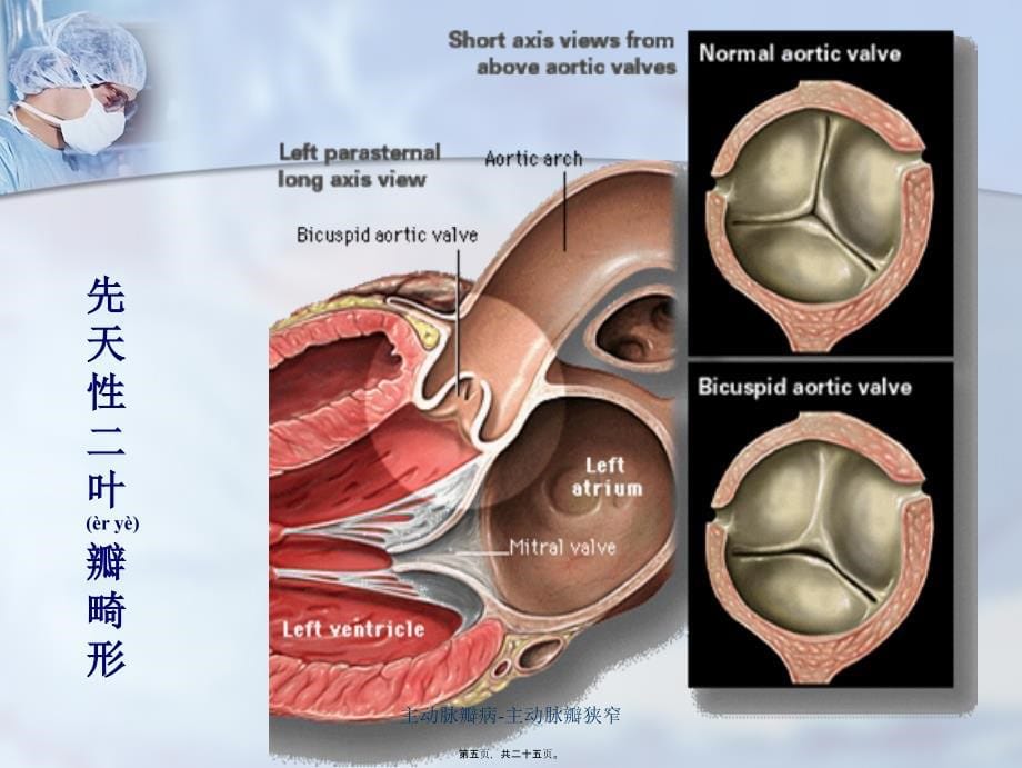 主动脉瓣病主动脉瓣狭窄课件_第5页