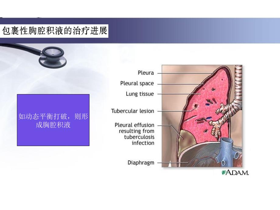 包裹性胸腔积液的治疗进展_第4页