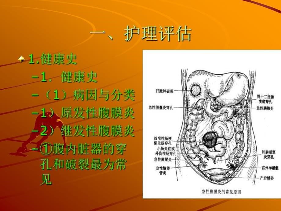 第16章急性腹膜炎与腹部损伤病人的护理_第5页