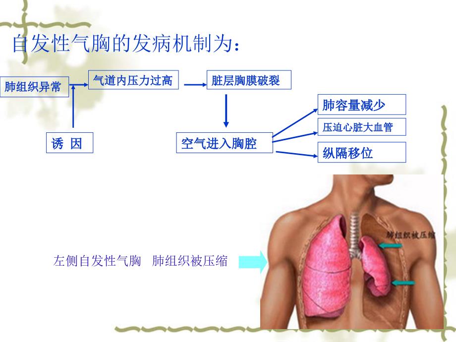 气胸的急救及护理_第4页