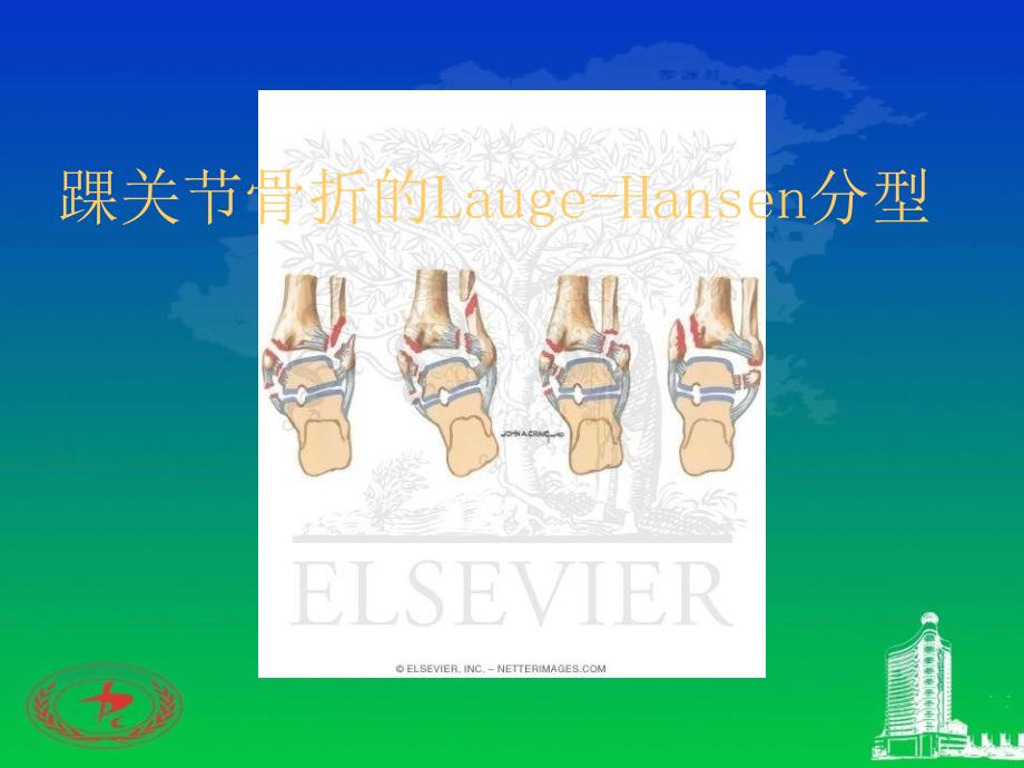 踝关节骨折的Lauge-Hansen分型_第1页