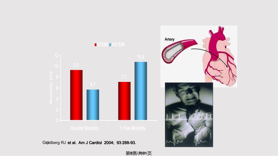 ACS抗凝治疗新进展与中国专家共识完善实用教案_第3页